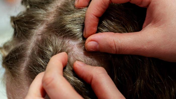 Sonhar com Lêndea: com Piolho, na Cabeça, no Corpo e Saltando